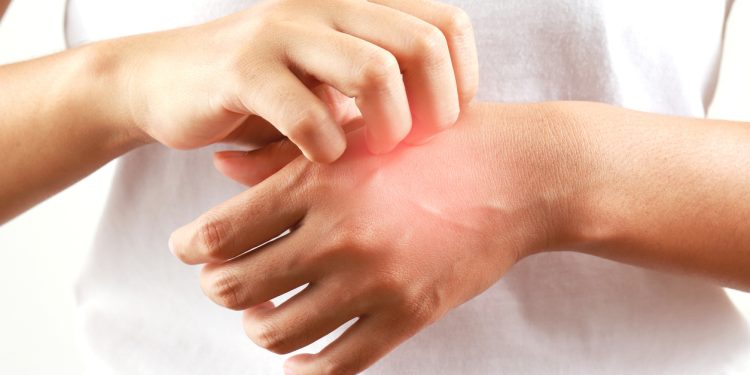 Τι-είναι-το-αλλεργικό-σοκ-από-το-οποίο-πέθανε-ο-46χρονος-στο-Ναύπλιο:-Πότε-ένα-τσίμπημα-γίνεται-απειλητικό-για-τη-ζωή