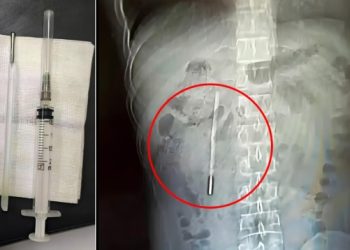 Δείτε-εικόνα:-Άνδρας-ζούσε-επί-20-χρόνια-με-ένα…-θερμόμετρο-στο-σώμα-του,-το-αφαίρεσε-μετά-από-έντονους-πόνους-στο-στομάχι