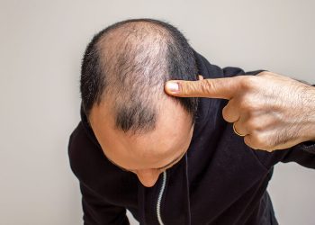 Ενέσεις-στο-κεφάλι-με-λίπος-του-ασθενούς-μειώνουν-δραματικά-την-απώλεια-μαλλιών