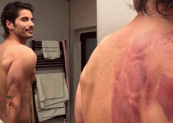 Ο-Γιώργος-Καράβας-αποκάλυψε-το-πρόβλημα-που-έχει-στην-ωμοπλάτη-–-Κάνει-βεντούζες-για-να-θεραπευτεί