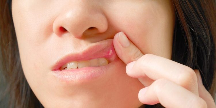 Τι-σημαίνουν-πραγματικά-οι-λευκές-κηλίδες-στο-στόμα-ή-στα-γεννητικά-όργανα